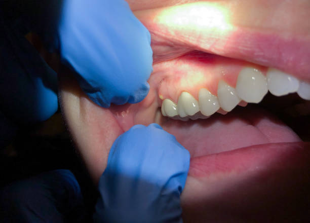 Best Dentist for Tooth Abscess  in Rising Sun, MD